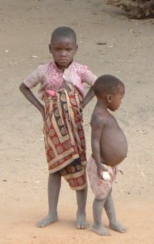 Waarom Zie Je Die Mensen In Hongersnood In Afrika Met Een Opgeblazen Buik En Krijgen Mensen Met Anorexia Dit Niet Goeievraag